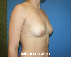 plastic-surgery-breast-augmentation